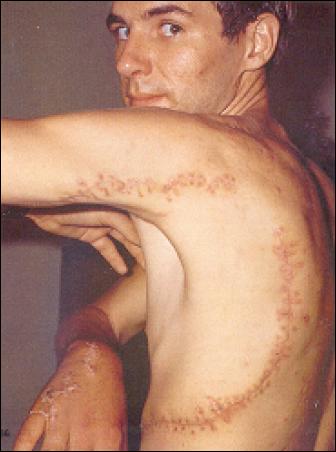 Rodney Fox shows his scars from a great white shark bite. Photo courtesy of Andrew Fox